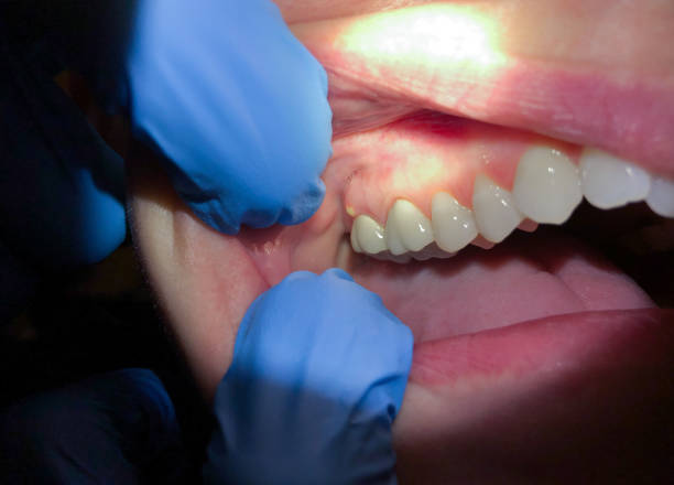 Best Knocked-Out Tooth Emergency  in New Bedford, MA
